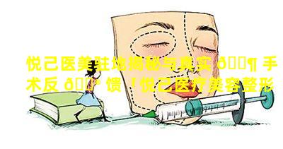 悦己医美驻地揭秘与真实 🐶 手术反 💮 馈「悦己医疗美容整形怎么样」